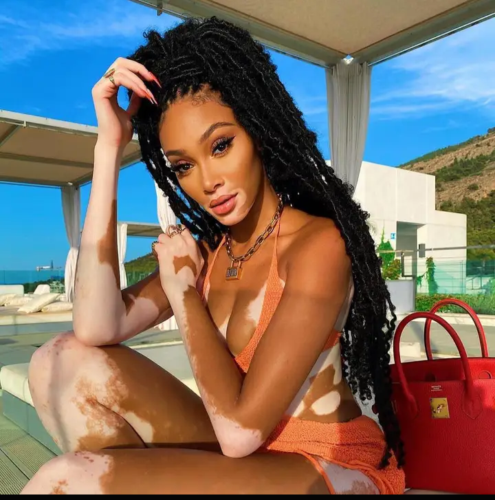 In this article, you will find everything you need to know Winnie Harlow net worth, age, family, parents, husband, boyfriend state of origin, modeling career, real name, and wiki profile