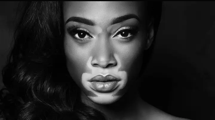 In this article, you will find everything you need to know Winnie Harlow net worth, age, family, parents, husband, boyfriend state of origin, modeling career, real name, and wiki profile